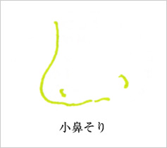小鼻そり